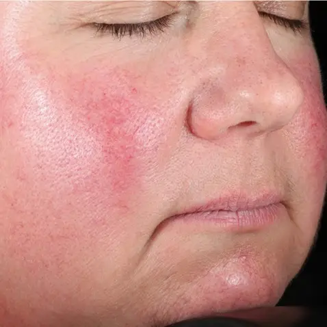 BEFORE Courtesy of Eric Bernstein, MD, MSE *Results may vary
