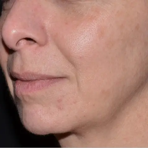 BEFORE Courtesy of Lutronic Research Clinic *Results may vary