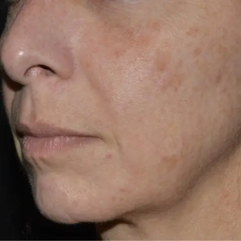 BEFORE Courtesy of Lutronic Research Clinic *Results may vary