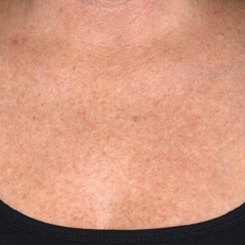 AFTER Lutronic Platform(s): DermaV Dates for Post Treatment - 30D Post-1 Tx