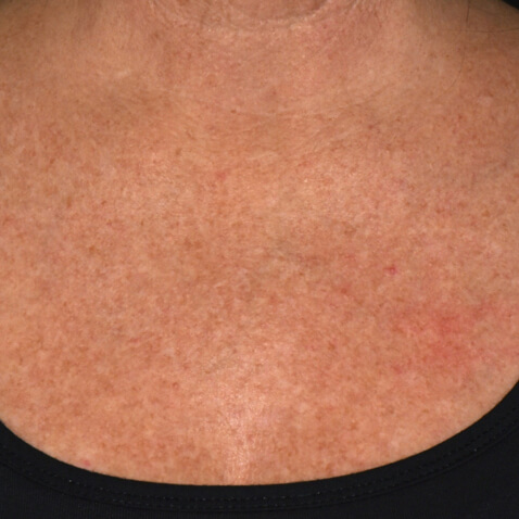 BEFORE Courtesy of Eric Bernstein, MD, MSE *Results may vary