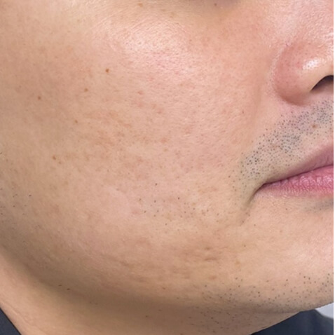 AFTER Lutronic Platform(s): Hollywood Spectra Dates for Post Treatment - 3 TX