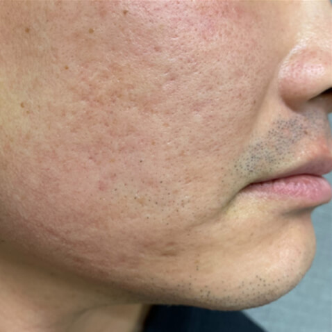 BEFORE Courtesy of James Y. Wang, MD *Results may vary