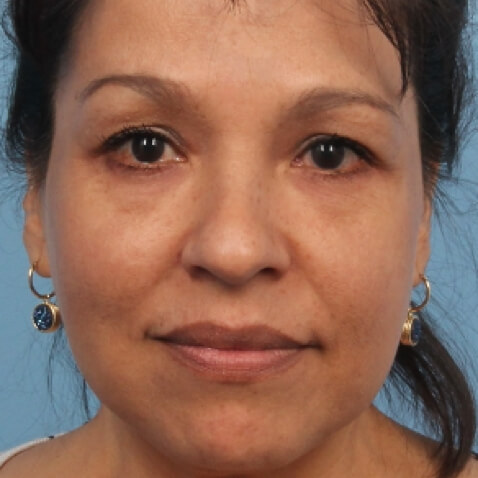 AFTER Lutronic Platform(s): Hollywood Spectra Dates for Post Treatment - 7 TX