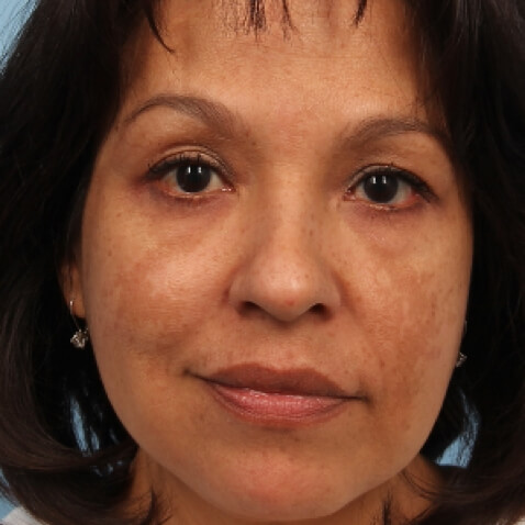BEFORE Courtesy of Melanie Palm, MD, MBA *Results may vary