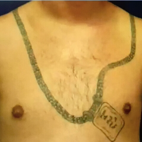 BEFORE Courtesy of Fabian P. Rivera, MD *Results may vary