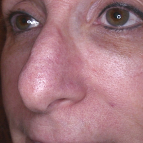 AFTER Lutronic Platform(s): Healite Indication(s): Rosacea