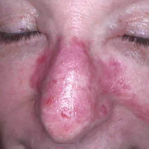 BEFORE Courtesy of Bettina Rummelein, MD *Results may vary