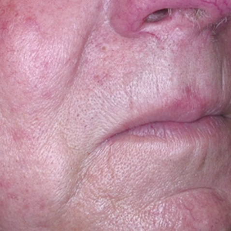AFTER Lutronic Platform(s): Healite Indication(s): Swelling and Redness