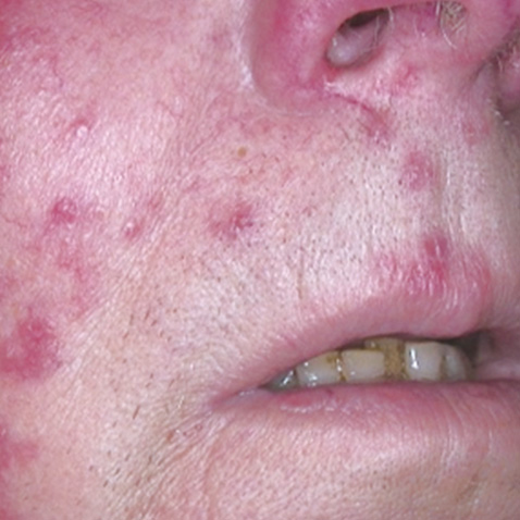 BEFORE Courtesy of Bettina Rummelein, MD, Switzerland *Results may vary