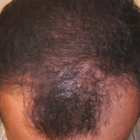 Androgenic_Alopecia_After-1 Androgenic_Alopecia_After-1