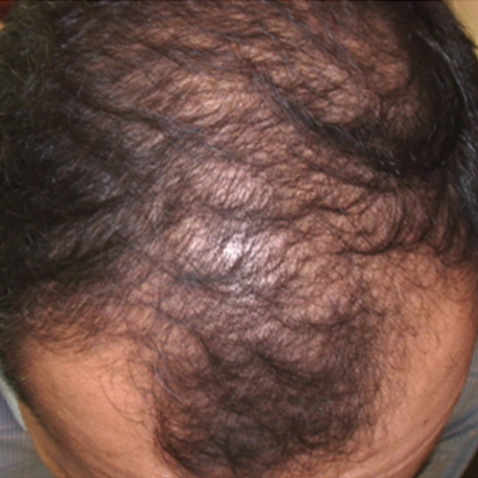 Androgenic_Alopecia_Before-1 Androgenic_Alopecia_Before-1