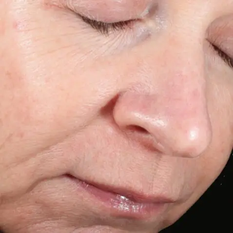 DermaV_AFTER_1_Dr._Eric_Bernstein-1 DermaV_AFTER_1_Dr._Eric_Bernstein-1