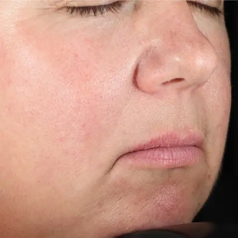 DermaV_AFTER_2_Dr._Eric_Bernstein DermaV_AFTER_2_Dr._Eric_Bernstein