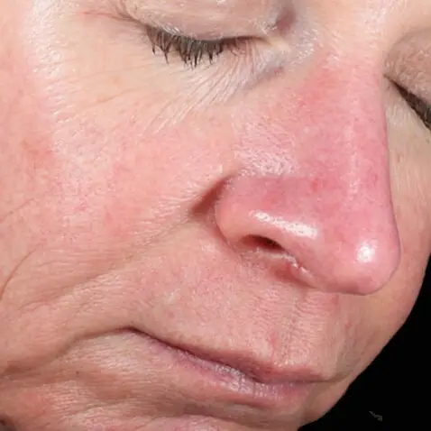 DermaV_BEFORE_1_Dr._Eric_Bernstein-1-1 DermaV_BEFORE_1_Dr._Eric_Bernstein-1-1